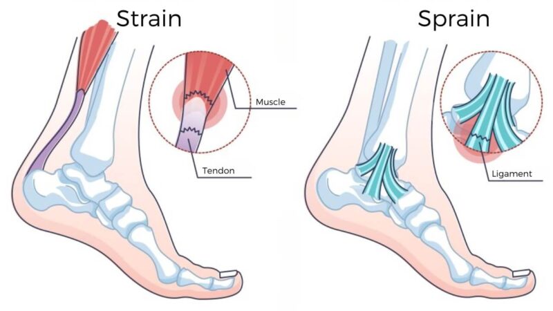 Strain vs Sprain - Illustration